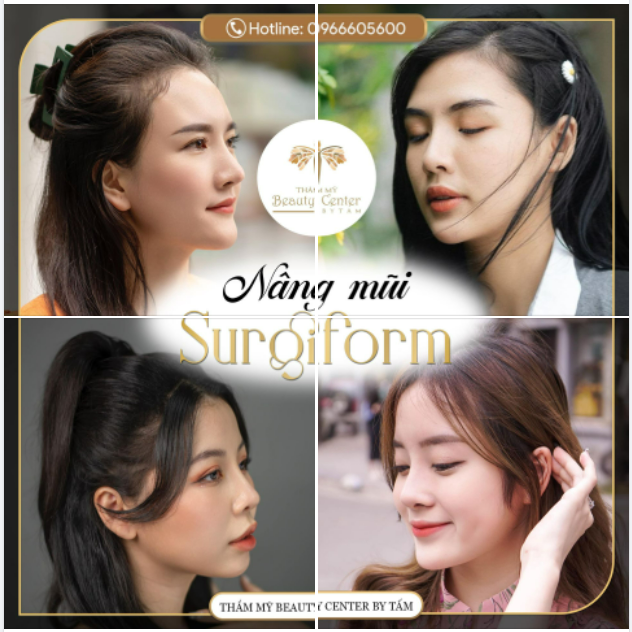Nâng mũi Surgiform kiến tạo hàng ngàn dáng mũi xinh cho khách hàng tại Tấm