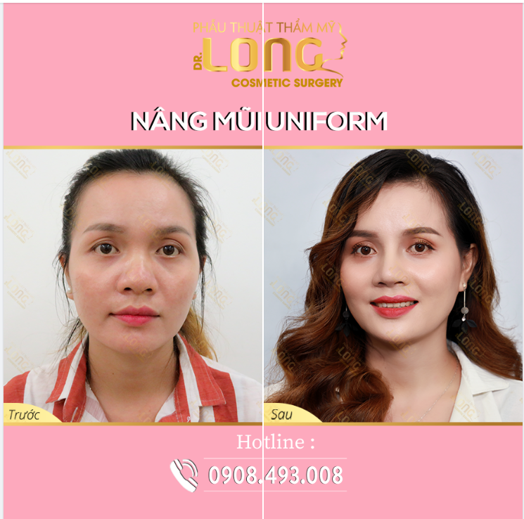 Nâng mũi tại PTTM Bác sĩ Long giúp bạn thay đổi diện mạo đón hè rực rỡ.