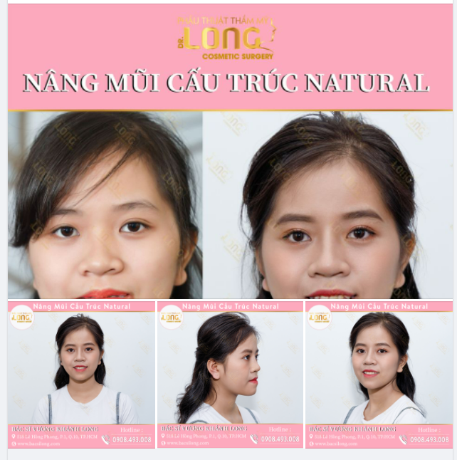 NÂNG MŨI THAY ĐỔI ĐẾN 70-80 NHAN SẮC CỦA BẠN
