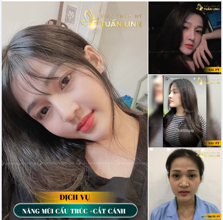 ''Nâng mũi xong ai cũng khen em trẻ và đẹp hơn''