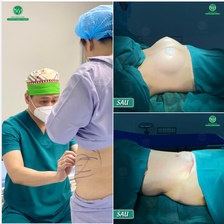 NÂNG NGỰC + HÚT MỠ CĂNG DA BỤNG - COMBO HOT NHẤT HÈ NÀY!!