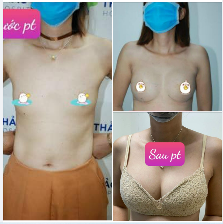 Nâng ngực nội soi 5D tại Bệnh Viện Quốc Tế Thảo Điền