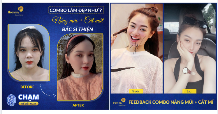 Nên cắt mí trước hay nâng mũi trước