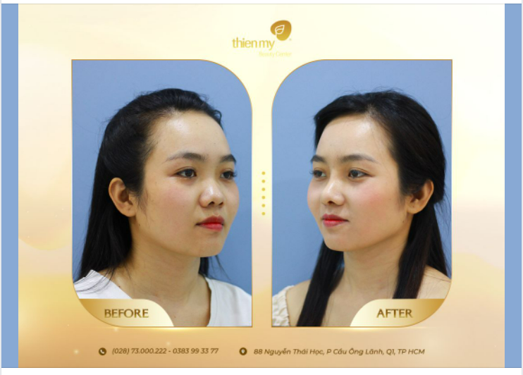 Nên nâng mũi 4-S 1 lớp, 2 lớp hay 3 lớp