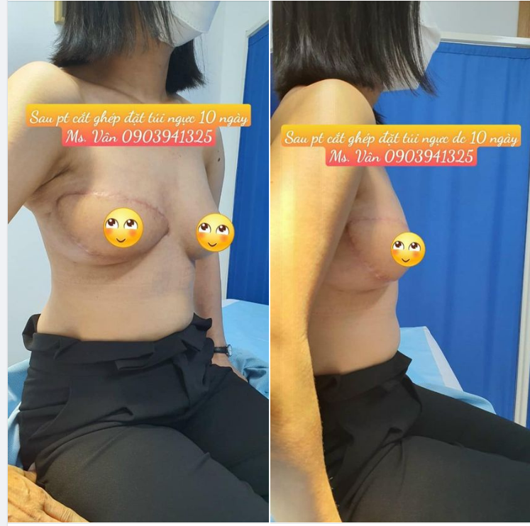 Nếu thực sự em là người có lỗi. Thì lỗi của em là quá đỗi ngây thơ. TÁI TẠO NGỰC SAU ĐIỀU TRỊ UNG THƯ VÚ
