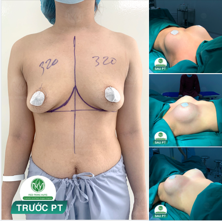 NGỰC ĐẸP - CĂNG TRÒN LÀ VÌ NÂNG NGỰC ĐẶT TÚI MENTOR