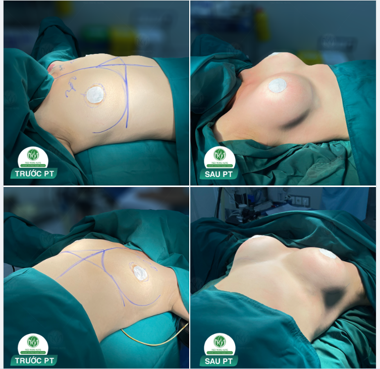 NGỰC ĐẸP NHƯ MƠ CHỈ VỚI 52TRIỆU
