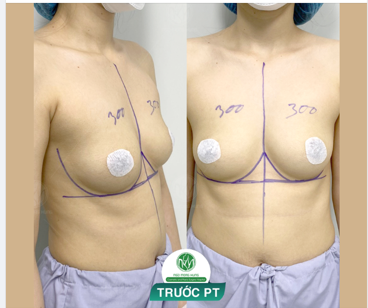 NGỰC NỘI SOI 300cc CHO KHÁCH HÀNG