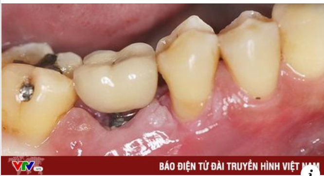 Nguy hiểm tiềm ẩn khi trồng implant giá rẻ, cẩn thận “tiền mất, tật mang