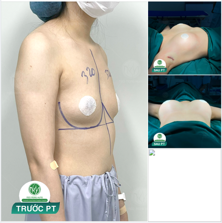 ... NHÀ CHỊ 3 NGƯỜI ĐÃ NÂNG NGỰC TẠI BỆNH VIỆN ...
