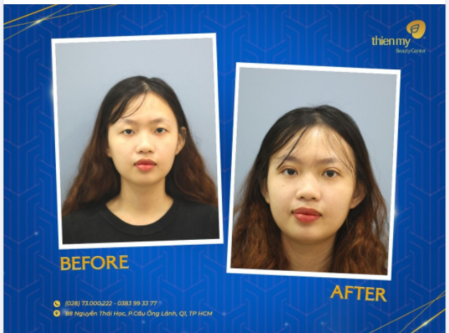 Nhấn mí có giữ được vĩnh viễn hay không