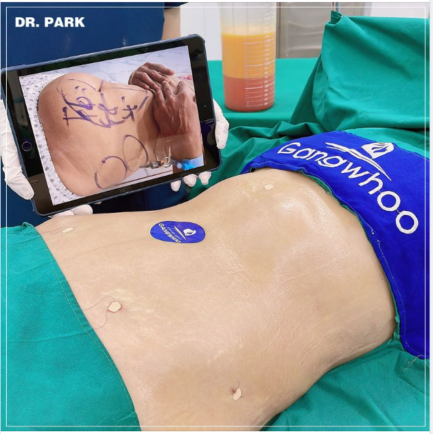 NHẸ TỰA LÔNG HỒNG SAU 60 PHÚT LIPO ULTRASOUND