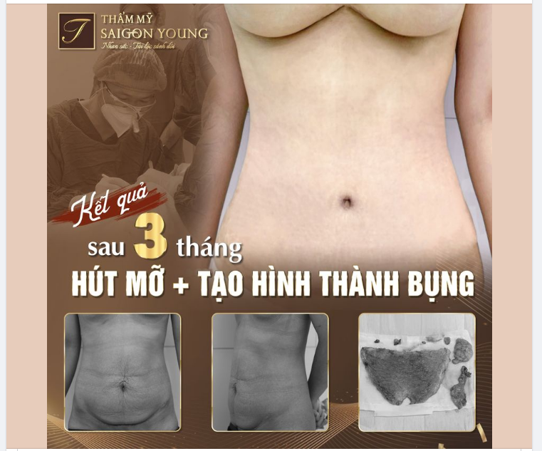 Nhiều chị em thắc mắc rằng sau phẫu thuật Hút Mỡ + Tạo Hình Thành Bụng sẽ nghỉ lại viện bao lâu