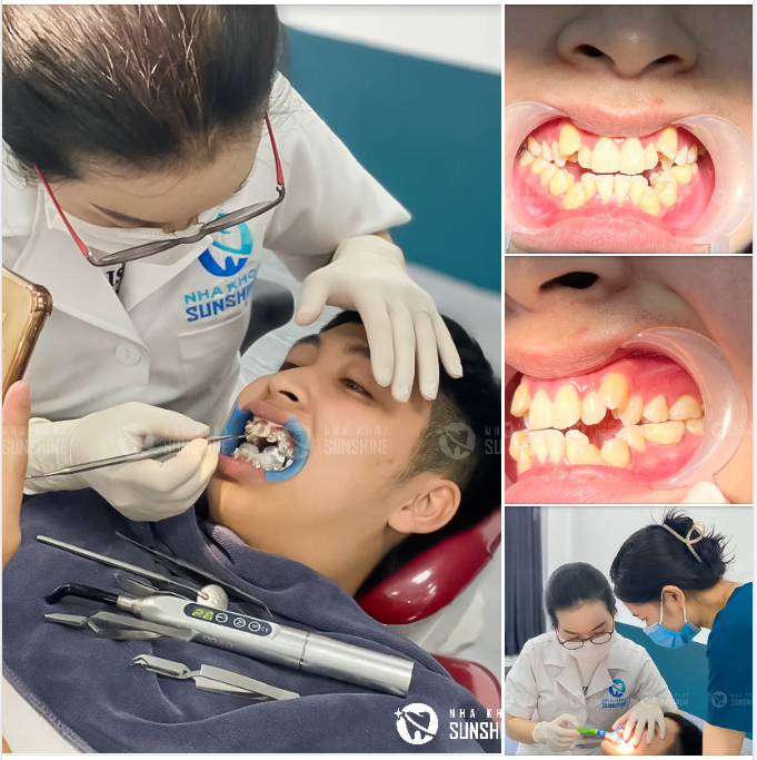 Nhiều người lo lắng rằng răng hàm sau khi điều trị và bọc sứ không thể thực hiện phương pháp niềng răng.