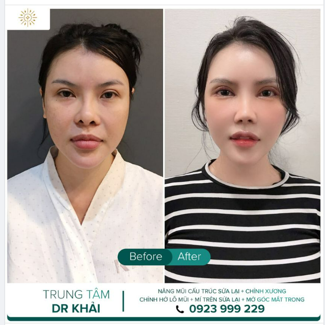 NHÌN KĨ MỚI THẤY CÙNG LÀ 1 NGƯỜI NHA CẢ NHÀ KẾT QUẢ CA NÂNG MŨI CẤU TRÚC SỬA LẠI+ CHỈNH XƯƠNG. MÍ TRÊN SỬA LẠI + MỞ GÓC MẮT TRONG