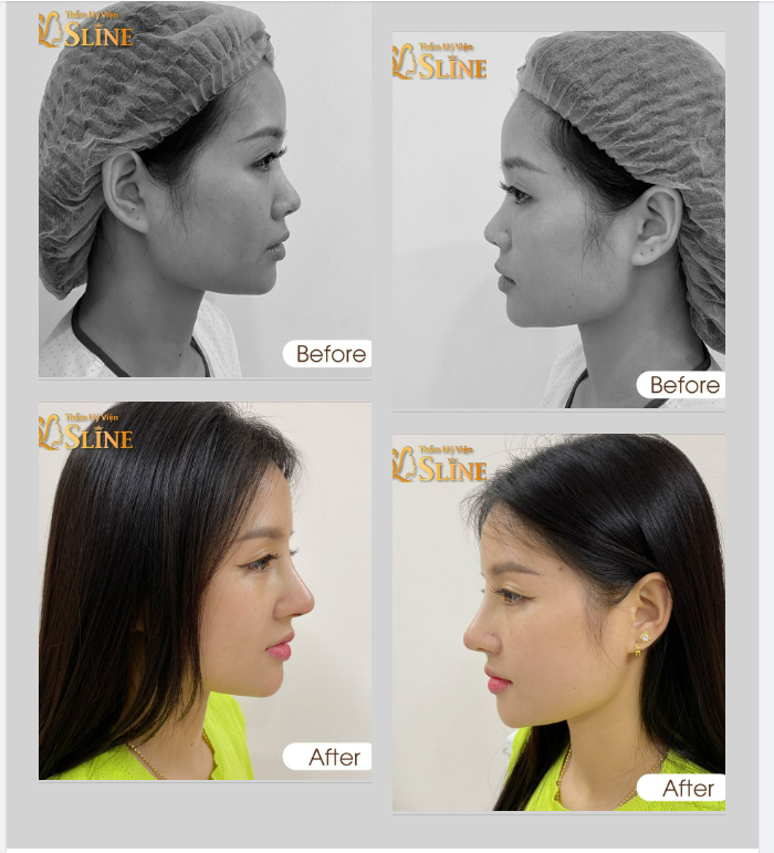 Nhìn ngắm lại kết quả Nâng Mũi Sau 10 Ngày tái khám