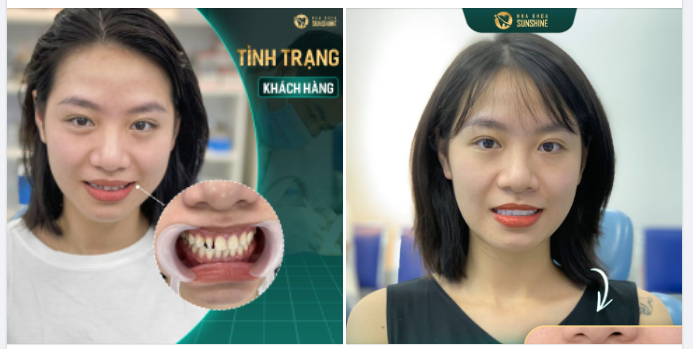 Nhờ công nghệ độc quyền Super Ultra Thin, Chỉ sau 48H, Sunshine đã giúp khách hàng đánh bay các khuyết điểm