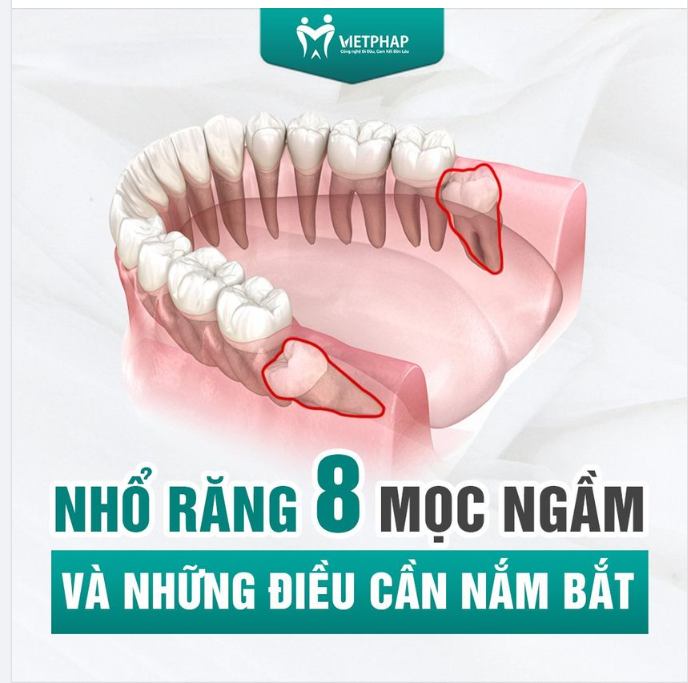 NHỔ RĂNG 8 MỌC NGẦM VÀ NHỮNG ĐIỀU CẦN NẮM BẮT