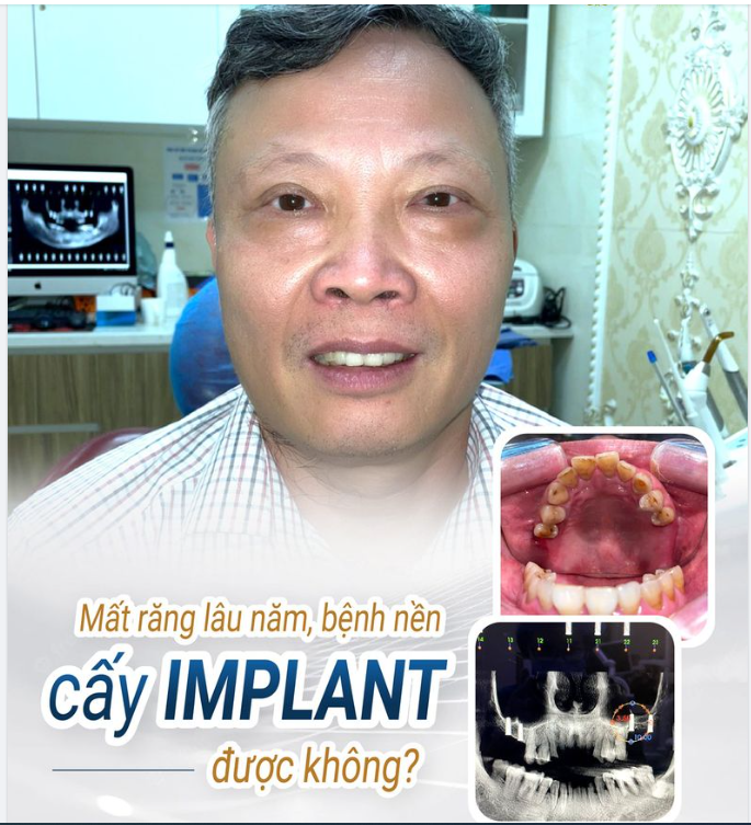 "NHƯ ĐƯỢC HỒI SINH" ĐÓ LÀ CẢM NHẬN CỦA CHÚ ĐẠT SAU KHI CẤY 4 RĂNG IMPLANT