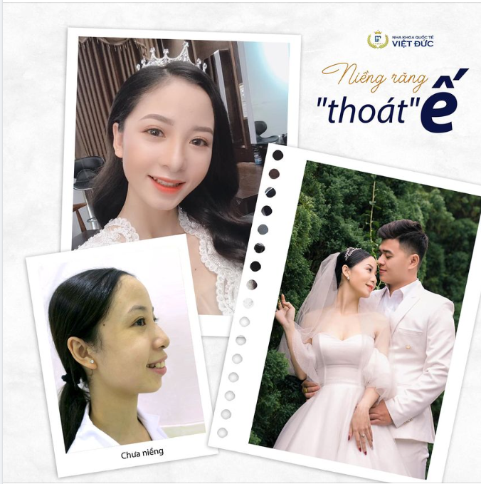 NIỀNG RĂNG AUTO THOÁT Ế 