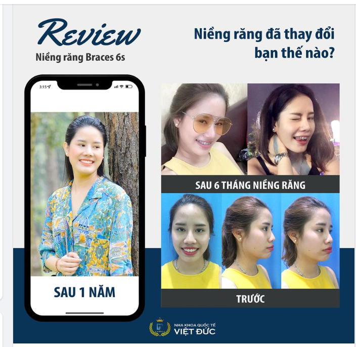 NIỀNG RĂNG, BẠN THAY ĐỔI THẾ NÀO?