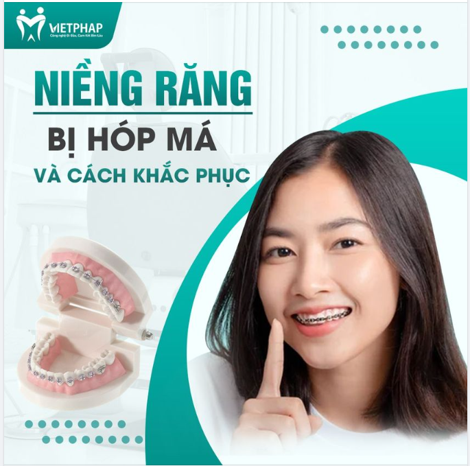 NIỀNG RĂNG BỊ HÓP MÁ VÀ CÁCH KHẮC PHỤC