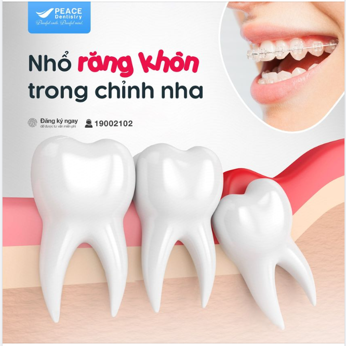 NIỀNG RĂNG CÓ CẦN NHỔ RĂNG KHÔN KHÔNG 