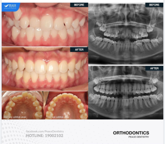 Niềng răng Invisalign cho bé tuổi teen 15 tuổi