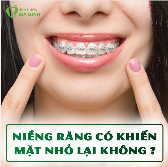 Niềng răng liệu có làm khuôn mặt trở nên thon gọn không?