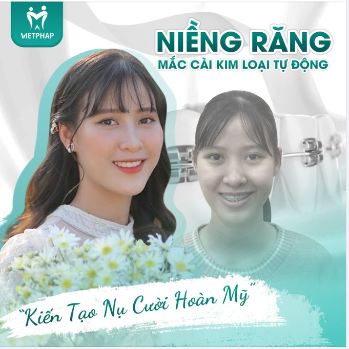 NIỀNG RĂNG MẮC CÀI KIM LOẠI TỰ ĐỘNG – KIẾN TẠO NỤ CƯỜI HOÀN MỸ