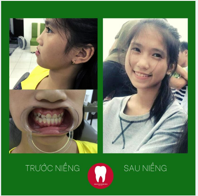NIỀNG RĂNG SỚM CHO CON NỤ CƯỜI TỰ TIN