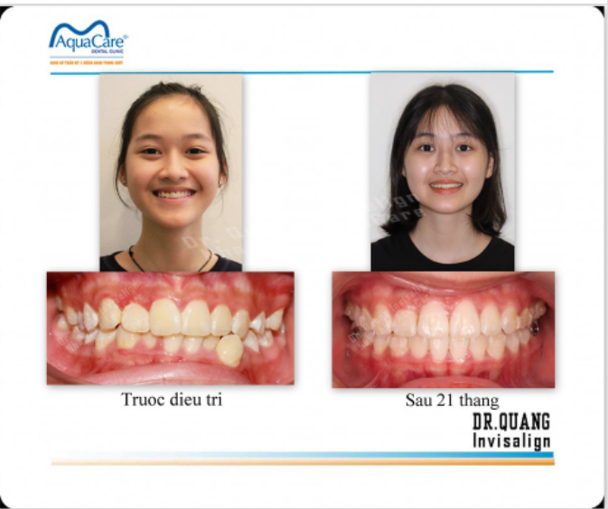 NIỀNG RĂNG SỚM CHO TRẺ LÀ BỐ MẸ ĐÃ TẶNG CON MÓN QUÀ VÔ GIÁ 