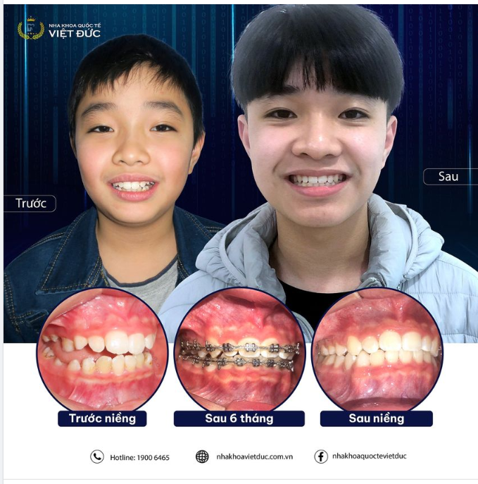 NIỀNG RĂNG SỚM - LỚN CON CÀNG TỰ TIN