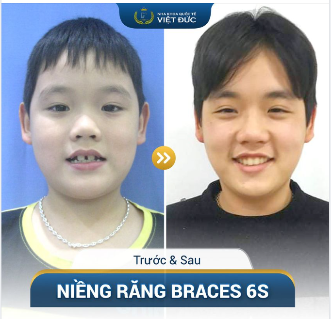 NIỀNG RĂNG SỚM - MÓN QUÀ VÔ GIÁ CHO CON