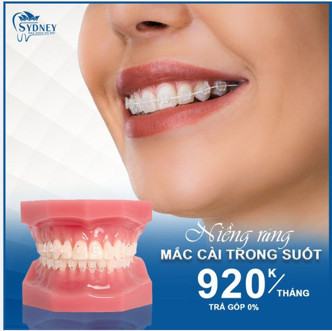 NIỀNG RĂNG TRONG SUỐT - BIẾT TRƯỚC KẾT QUẢ