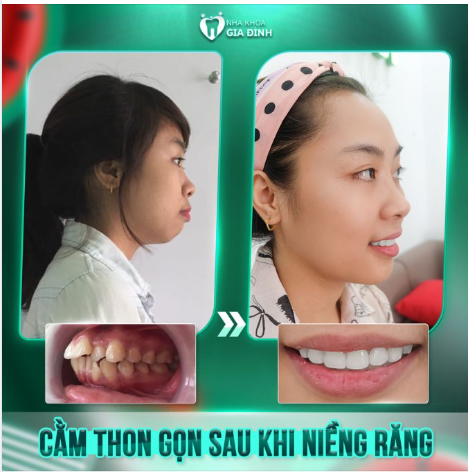 NIỀNG RĂNG XONG MẶT THON GỌN HƠN CÓ THẬT KHÔNG?