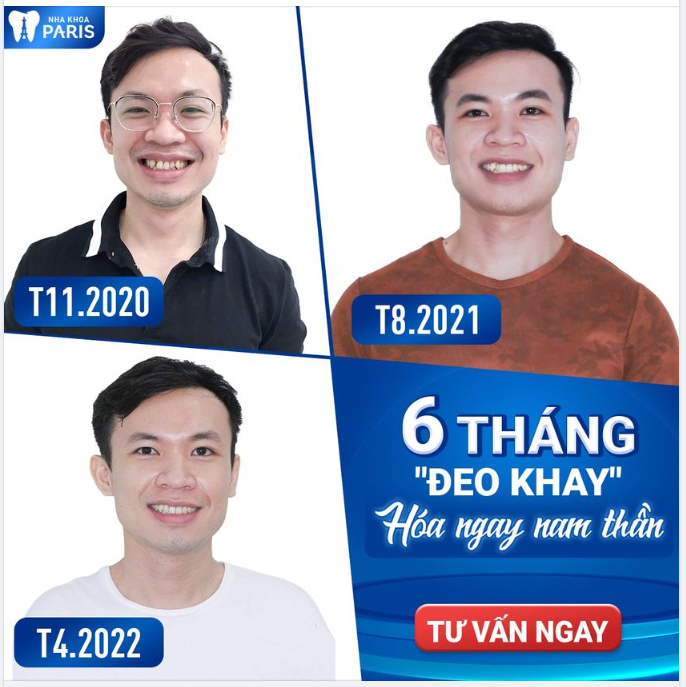 NIỀNG RĂNG  AN TOÀN CHUẨN BỆNH VIỆN