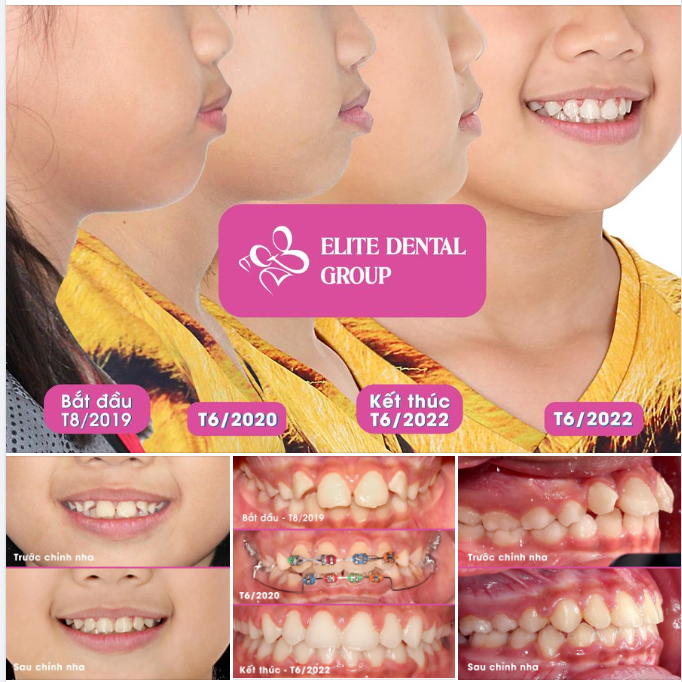 Ở ĐÂY LUÔN CÓ “VÍA CHỈNH NHA”, CÓ AI XIN KHÔNG