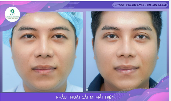 Phẫu thuật cắt mí mắt trên tại KAT đã giúp bạn tạm biệt đôi mắt không rõ nếp mí , sụp và buồn và trao lại cho bạn một ánh mắt to rõ hơn giúp gương mặt bạn sáng hơn và ko hề mất đi vẻ nam tính .