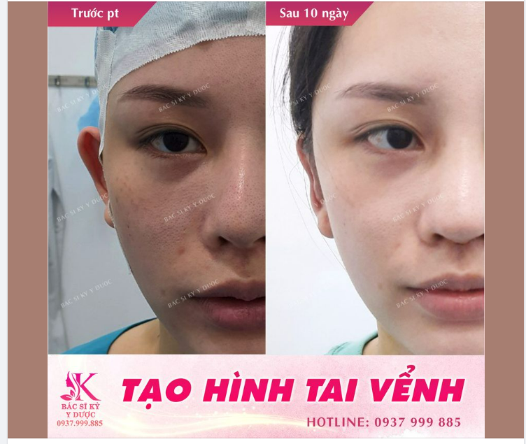 PHẪU THUẬT CHỈNH HÌNH TAI VỂNH KẾT HỢP XỬ LÝ SỤN TAI TẠO HÌNH VÀNH TAI ĐƯA VỀ CẤU TRÚC NGUYÊN BẢN TẠI Bác sĩ Kỳ Y Dược