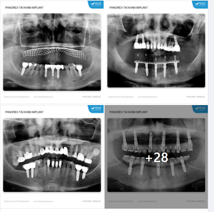 PHIM CHỤP X-QUANG TÁI KHÁM SAU KHI TRỒNG RĂNG IMPLANT