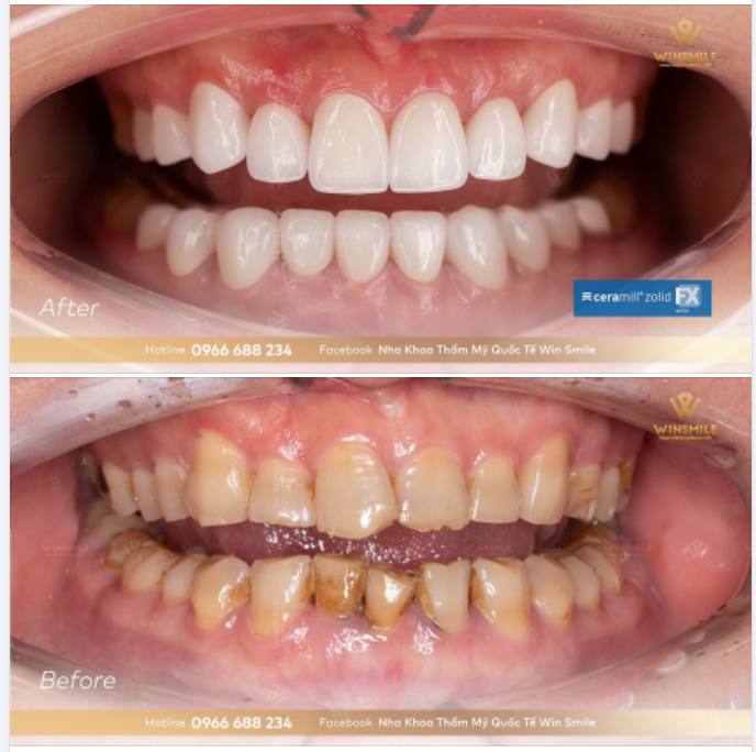 PHỤC HÌNH ĐỈNH CAO VỚI RĂNG SỨ CERAMILL