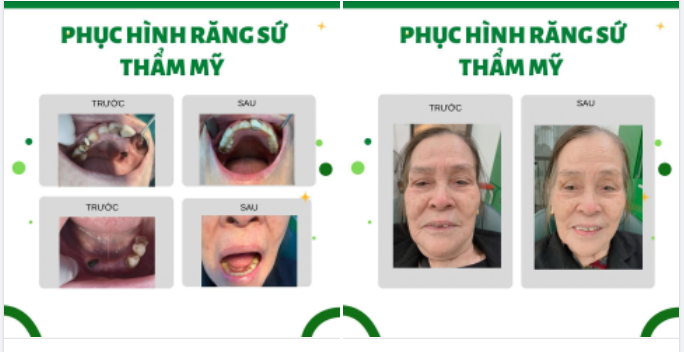 PHỤC HÌNH RĂNG SỨ THẦM MỸ