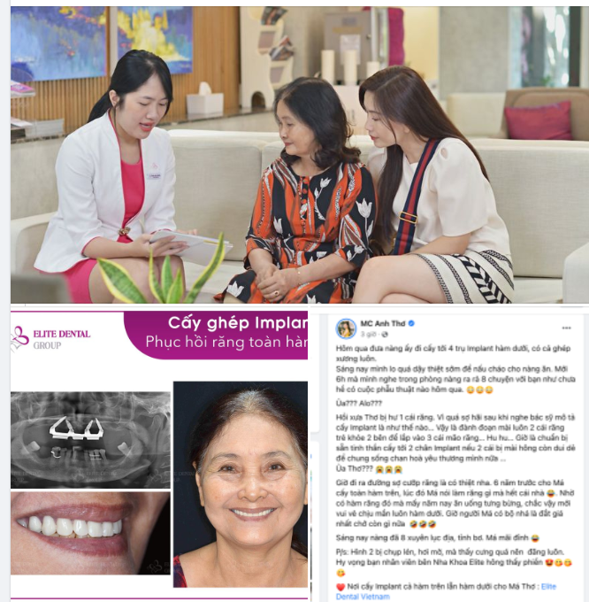 PHỤC HỒI MẤT NHIỀU RĂNG HÀM TRÊN VỚI TRỒNG IMPLANT TOÀN HÀM - KẾT QUẢ BỀN VỮNG SAU HƠN 5 NĂM ĐIỀU TRỊ.