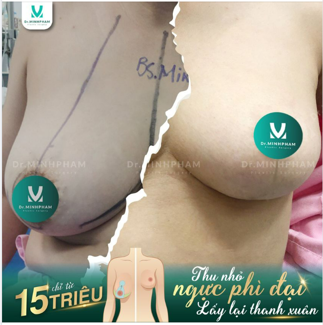Phương pháp xử lý V1 phì đại - Kĩ thuật độc quyền từ Dr. Minh Phạm
