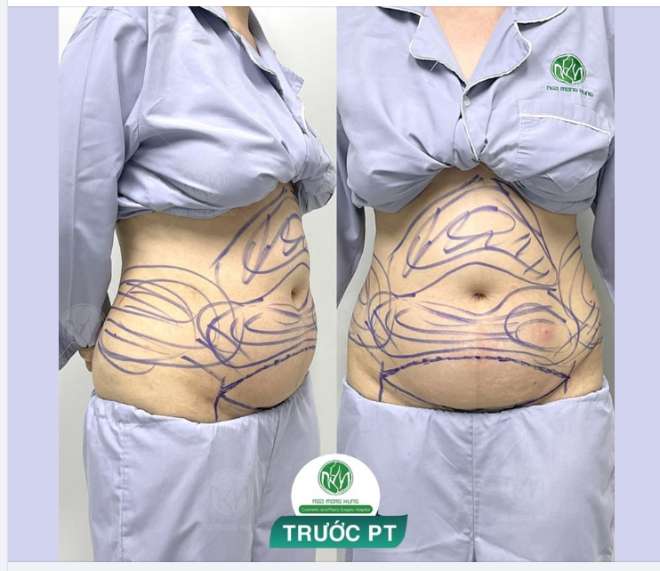 QUÁ TRÌNH CHUẨN BỊ CHO CA TẠO HÌNH VÒNG 2 CHO KH