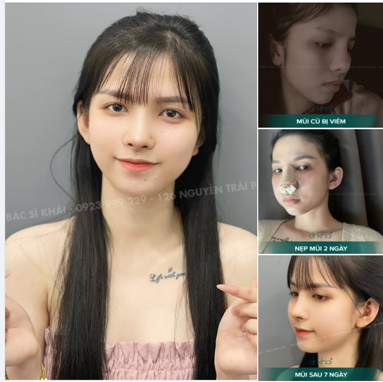 QUÁ TRÌNH TÌM LẠI VẺ ĐẸP SAU 7 NGÀY NÂNG MŨI CẤU TRÚC SỬA LẠI CHỈNH XƯƠNG