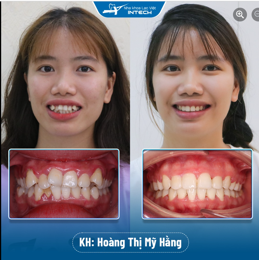 RĂNG DÀN ĐỀU - ĐÓN NỤ CƯỜI XINH NHỜ NIỀNG RĂNG X-MATRIX
