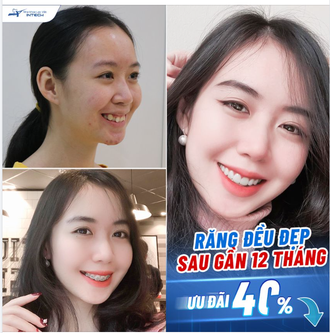 Răng đều đẹp, dàn đều khấp khểnh chỉ sau 12 tháng