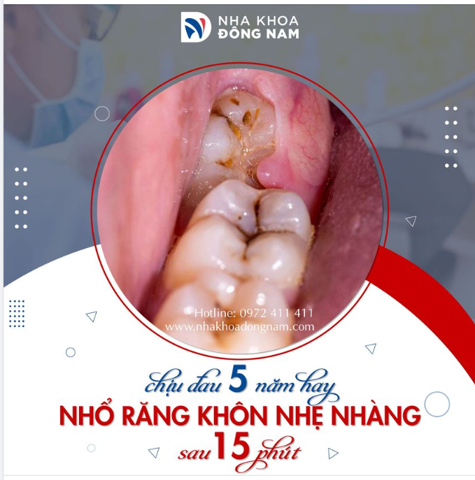 RĂNG KHÔN MỌC LỆCH, SAO KHÔNG NHỔ SỚM MÀ LẠI CHỊU ĐAU 